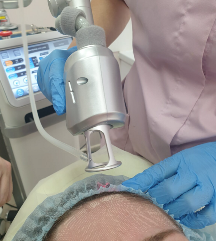 Самый современный метод решения проблемы шрамов, растяжек, а также преждевременного старения кожи и борьбы со следами постакне — лазерная СО2 шлифовка.