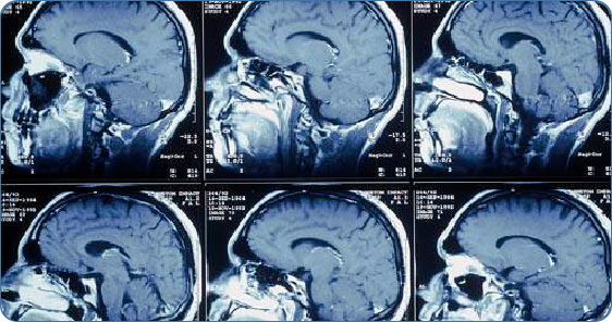 МРТ головного мозга - показания к обследованию.